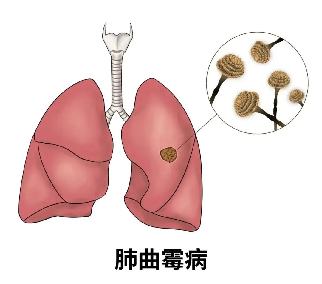 女子家中中招致肺部“发霉”,快检查你家可能也有→(图2) 图片